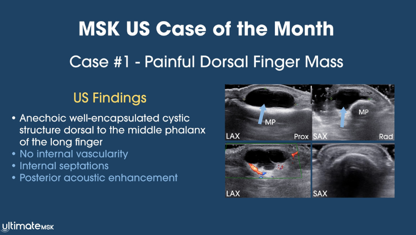 Painful Dorsal Finger Mass