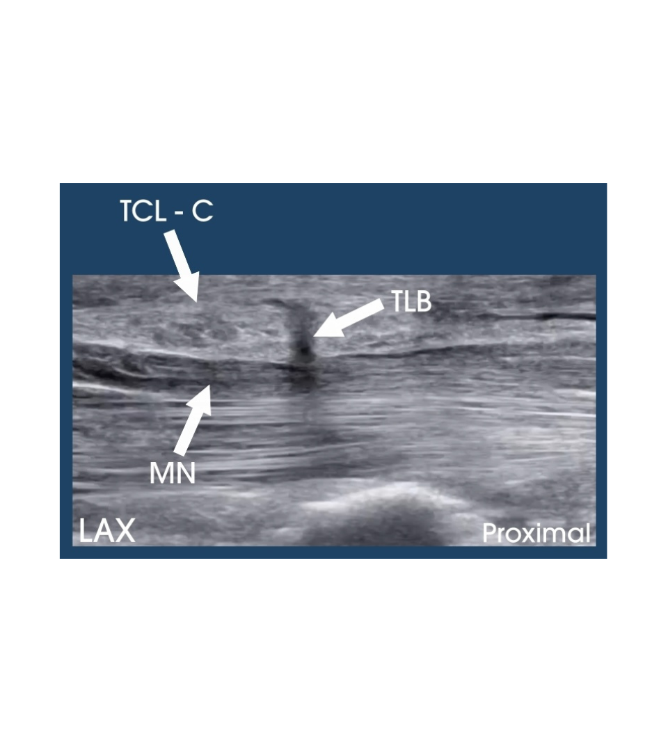 Transligamentous Branch of the Median Nerve
