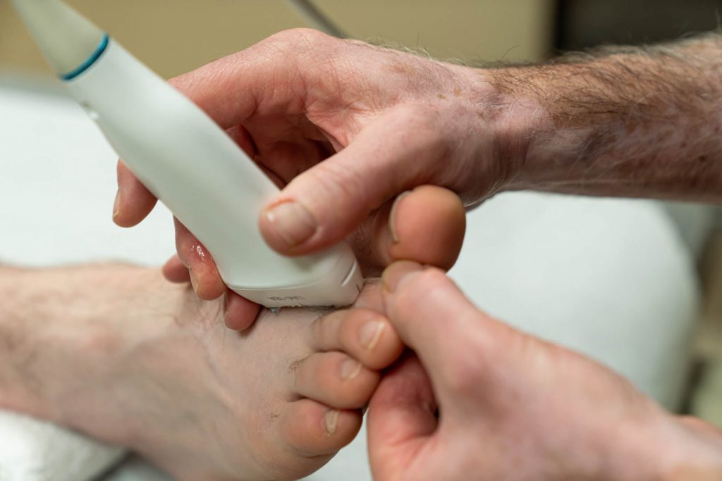 Close-up of a person's hands using an ultrasonic device on a patient's foot. The practitioner is holding the device against the bottom of the foot near the toes. The patient's foot is resting on a white towel.