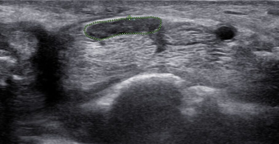 An ultrasound image showing a cross-sectional view with an irregularly shaped section outlined by a series of small dots near the center. The grayscale tones show varying tissue densities with no distinct anatomical structures visible.