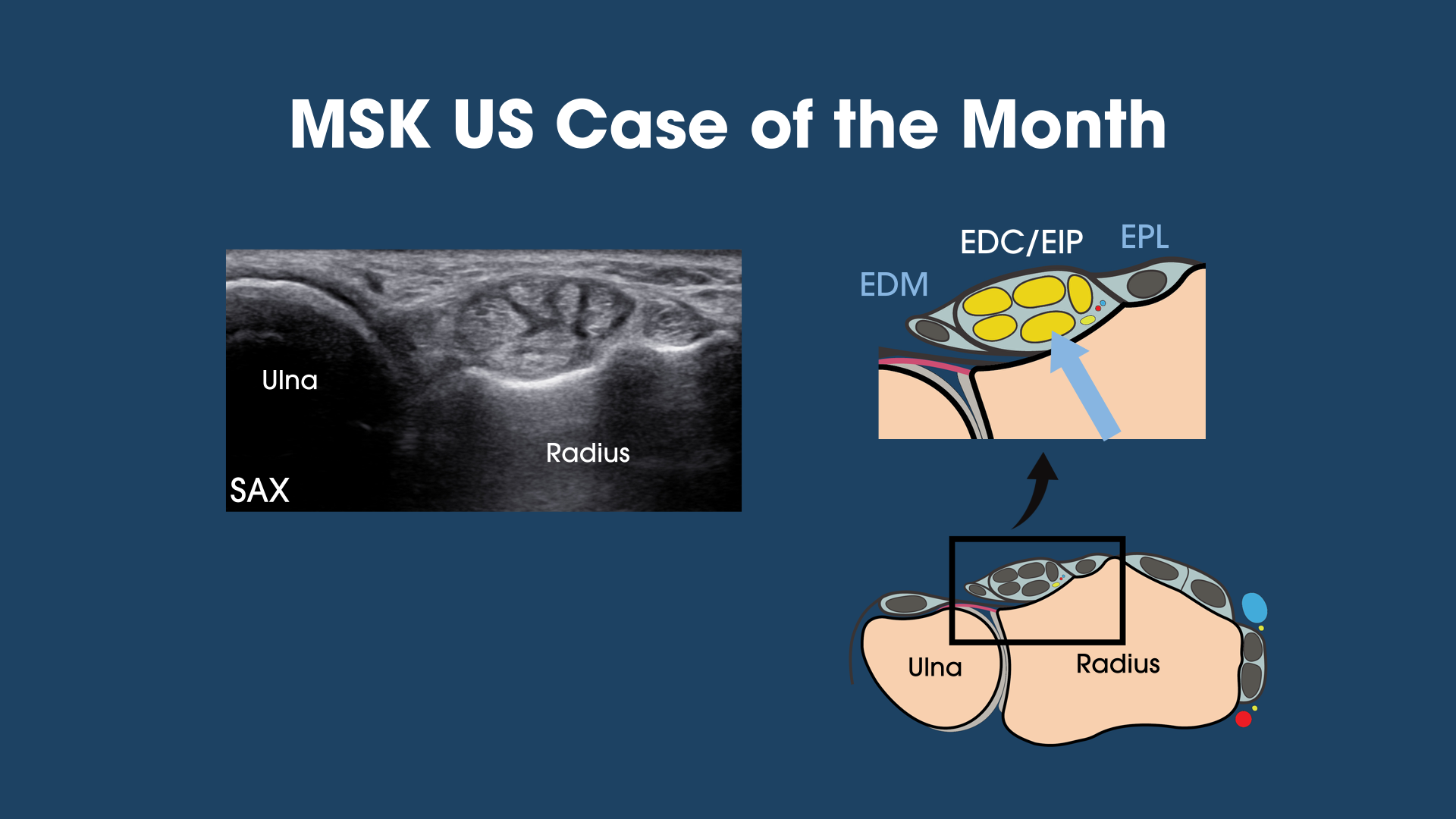 Painful Dorsal Wrist Mass