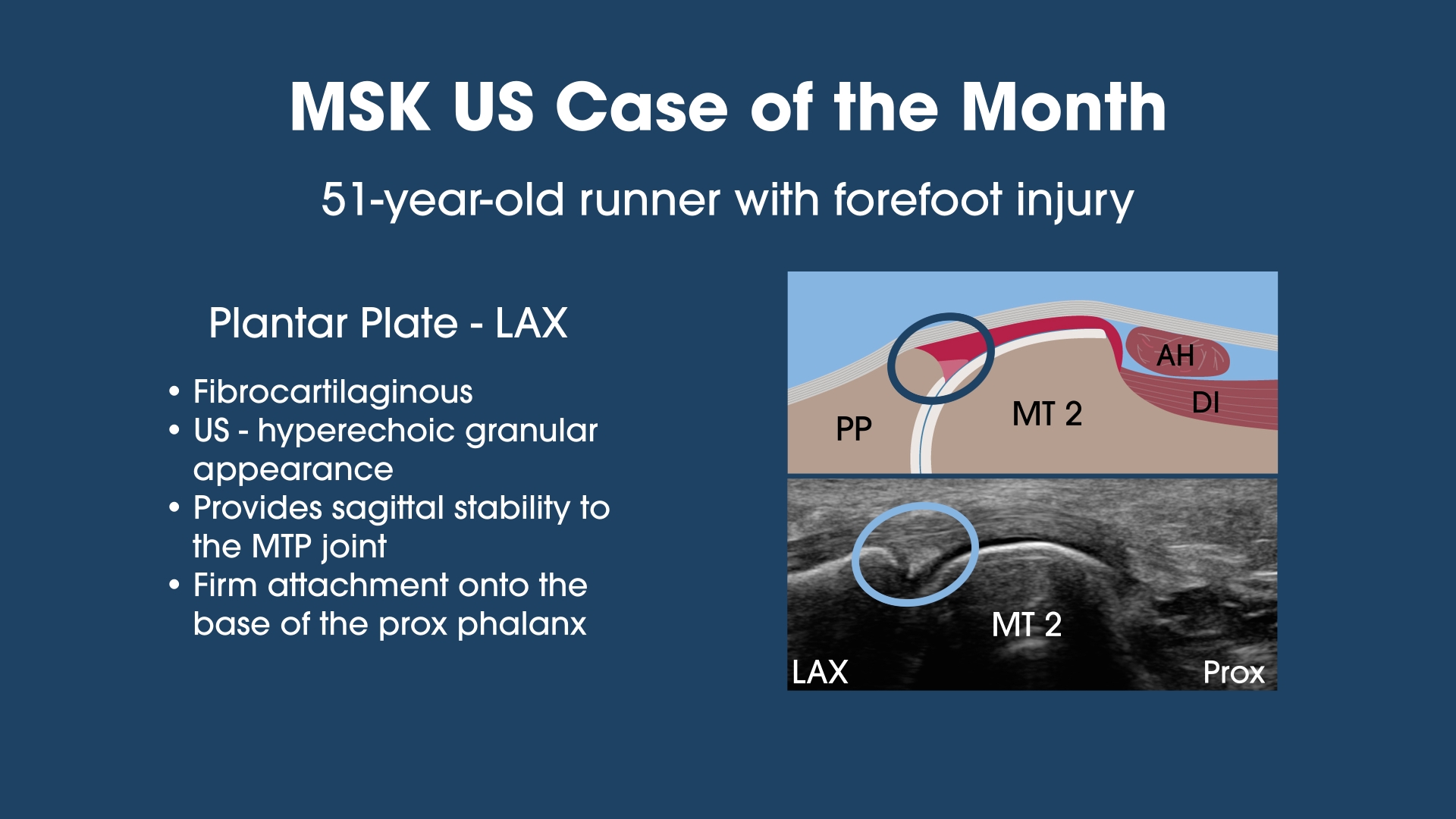 51-year-old runner with forefoot injury
