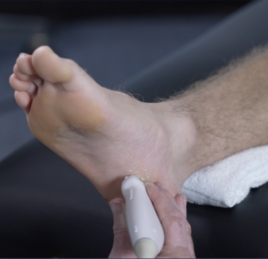 Plantar Hindfoot Pain after a Hilly Trail Hike