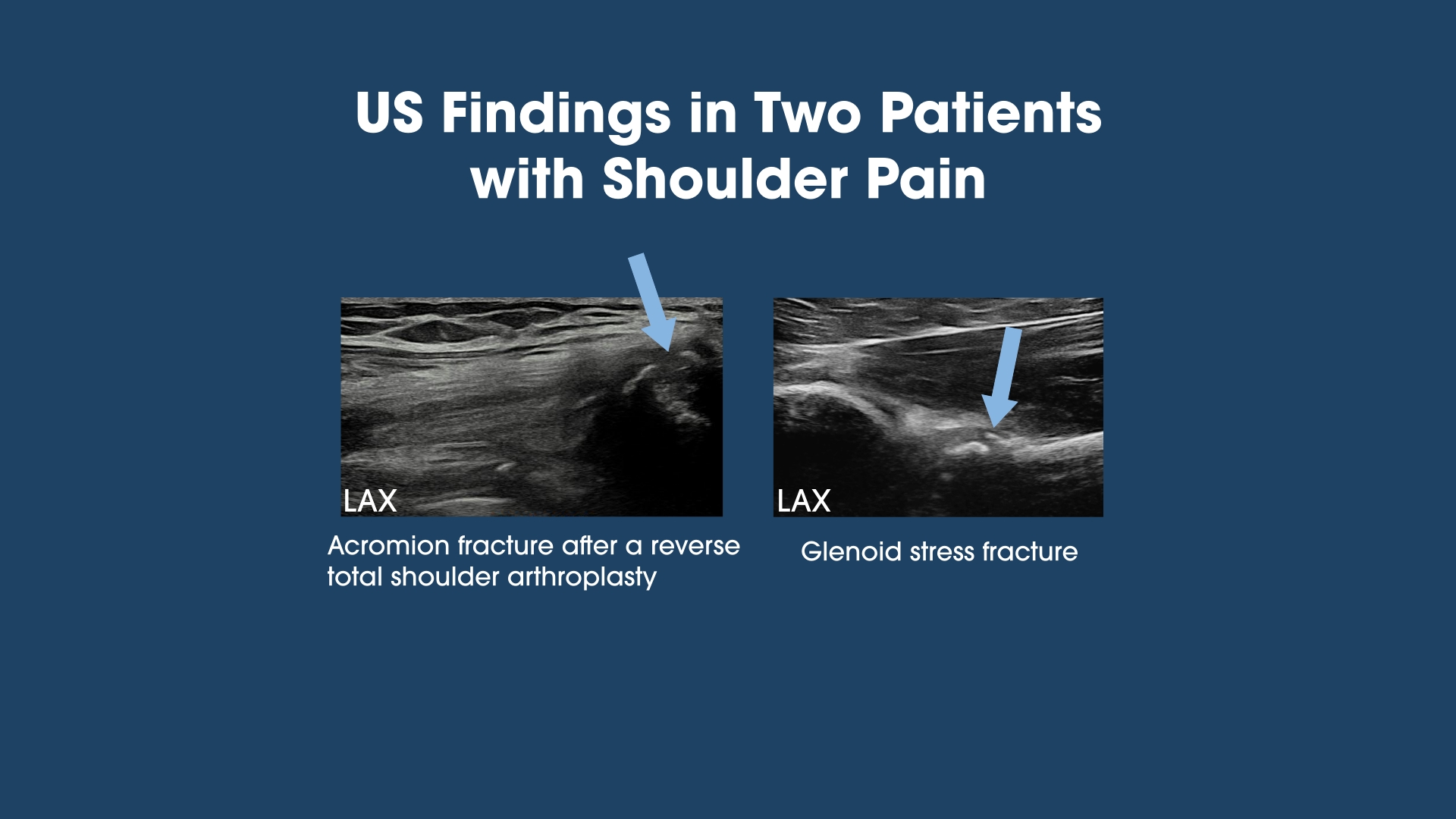 Ultrasound Detection of Two Unexpected Shoulder Fractures