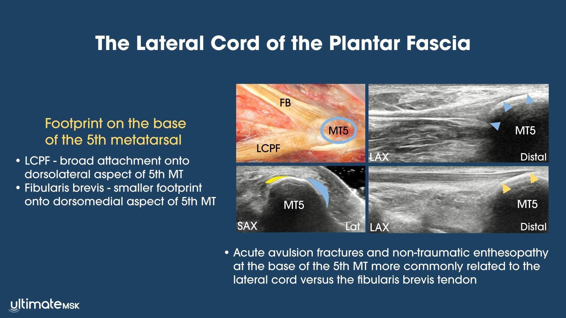 The Lateral Cord of the Plantar Fascia