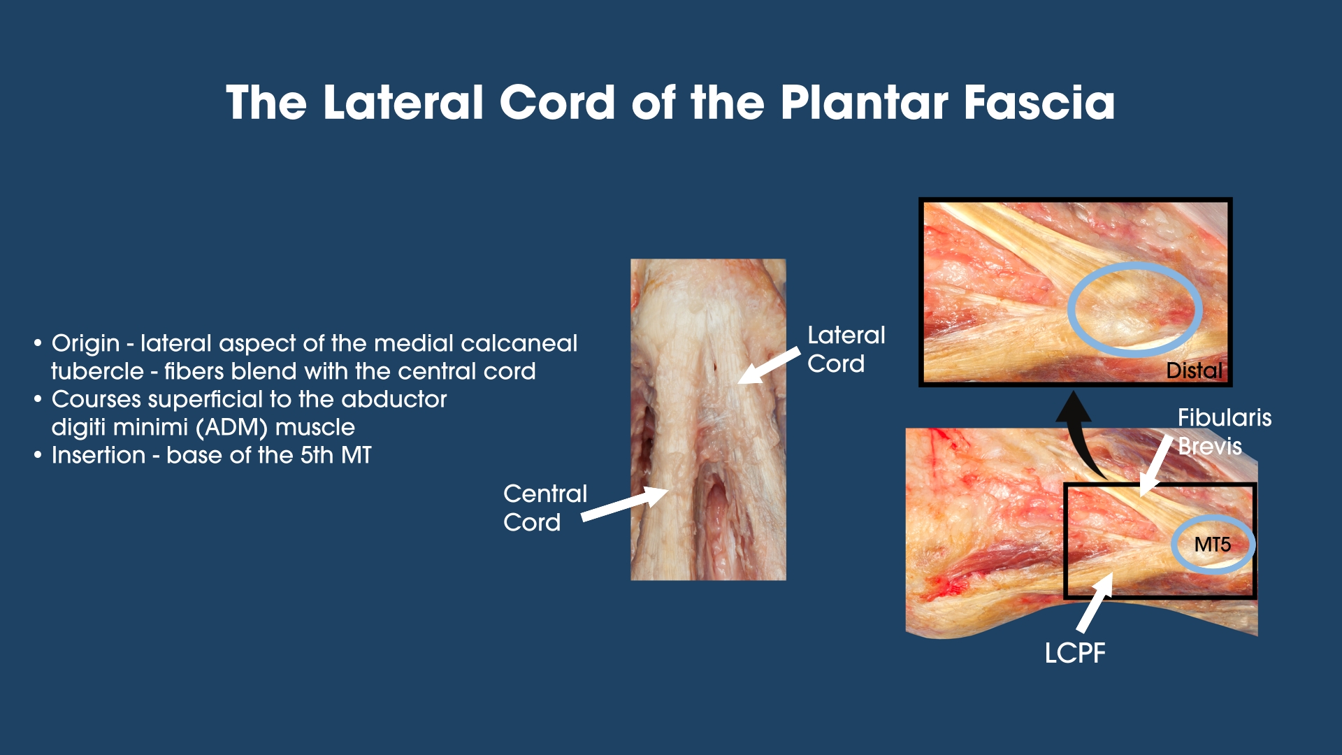 The Lateral Cord of the Plantar Fascia