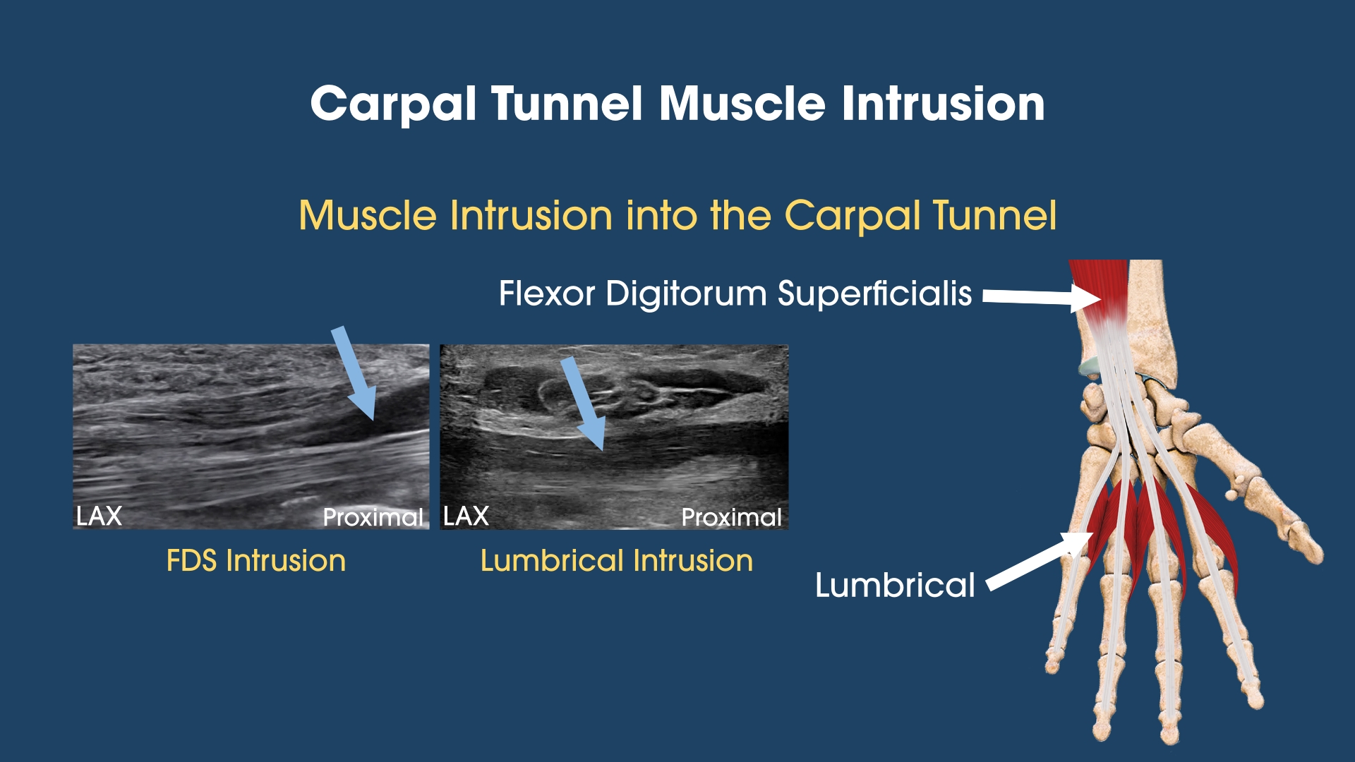 Carpal Tunnel Muscle Intrusion