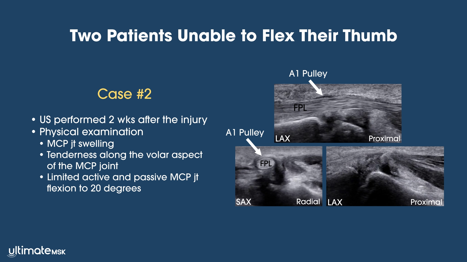 Two Patients Unable to Flex Their Thumb