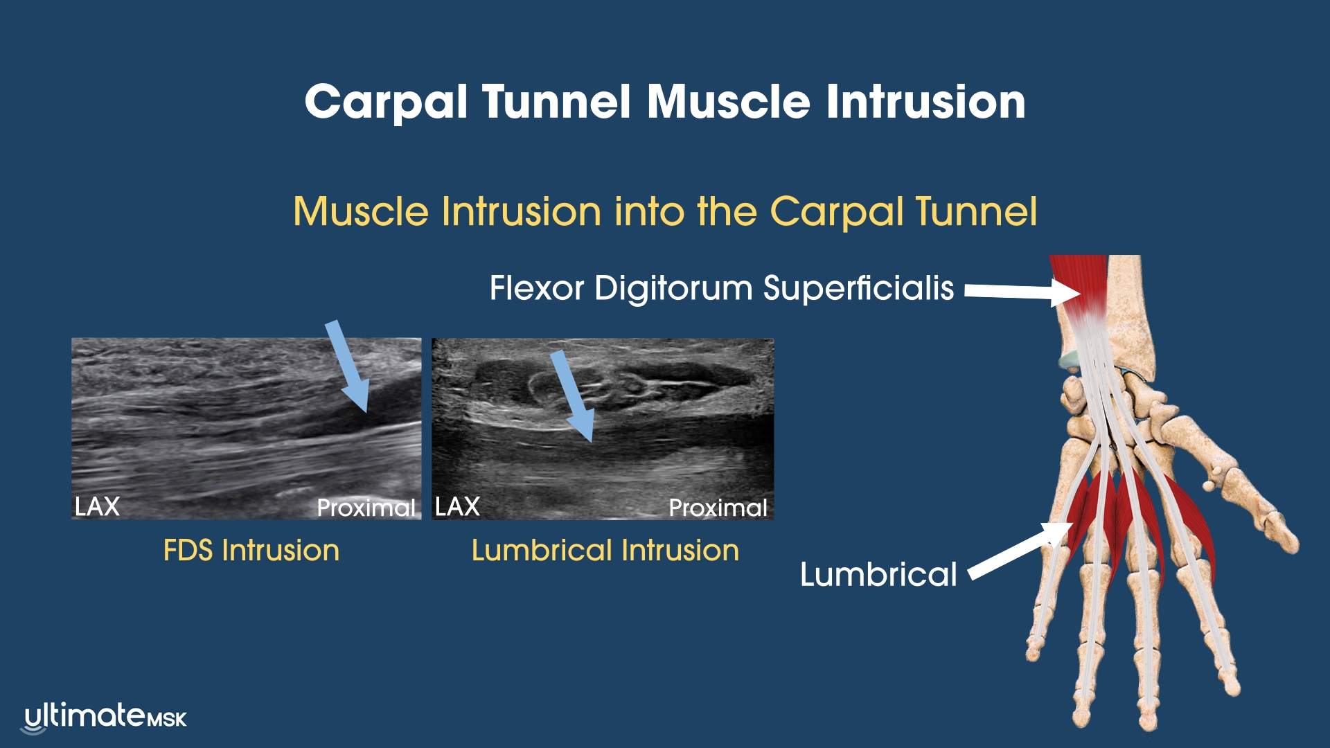 Carpal Tunnel Muscle Intrusion