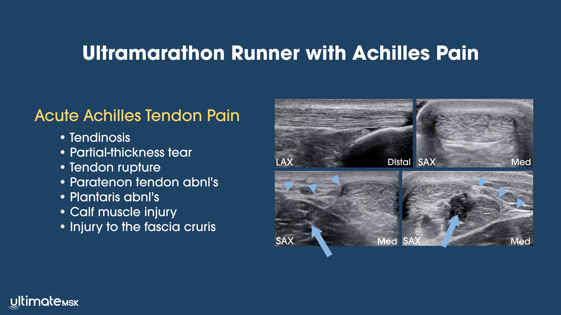 Ultramarathon Runner with Achilles Pain